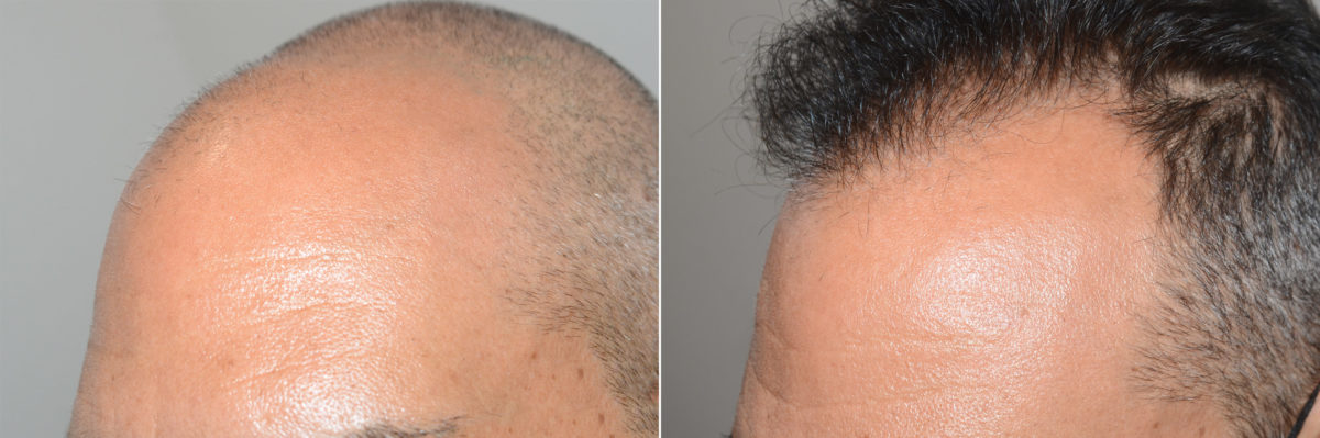 Hair Transplants for Men Before and after in Miami, FL, Paciente 119235