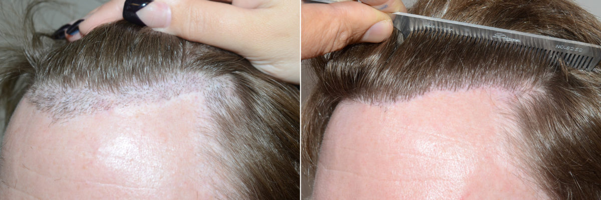 Reparative Hair Transplant Before and after in Miami, FL, Paciente 119355