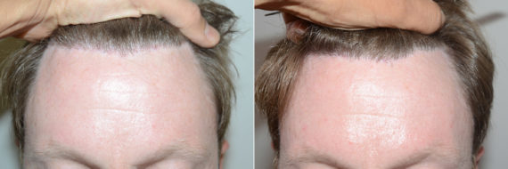 Reparative Hair Transplant Before and after in Miami, FL, Paciente 119355