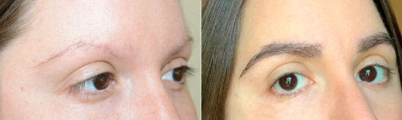 Eyebrow Before and after in Miami, FL, Paciente 119576