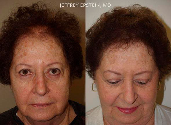 Woman Hair replacement frontal view before and after photo patient 1