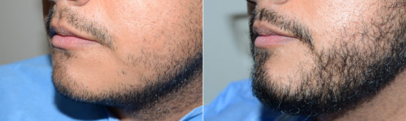 Trasplante de Pelo Facial Before and after in Miami, FL, Paciente 119884