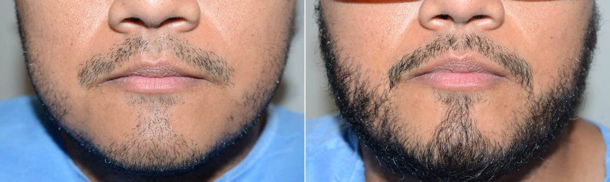 Facial Hair Transplant Before and after in Miami, FL, Paciente 119871