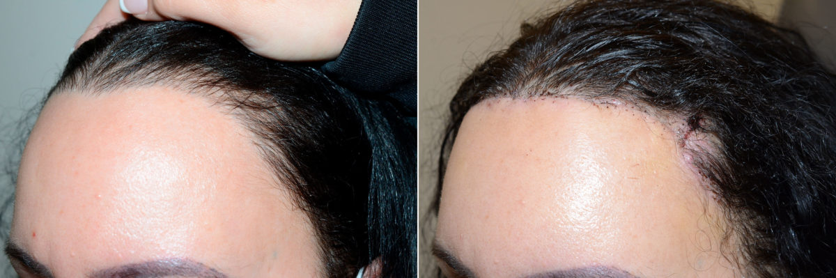 Forehead Reduction Surgery Before and after in Miami, FL, Paciente 119911