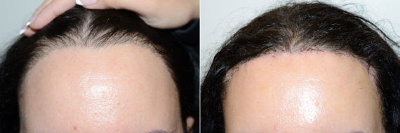 Hairline Advancement Before and after in Miami, FL, Paciente 119911