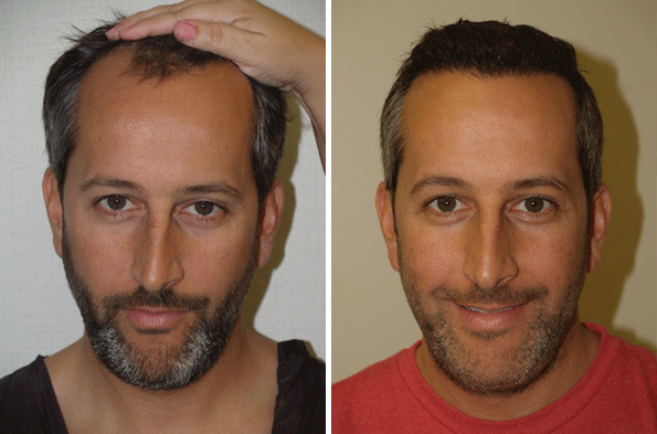 Hair Transplants for Men Before and after in Miami, FL, Paciente 37586