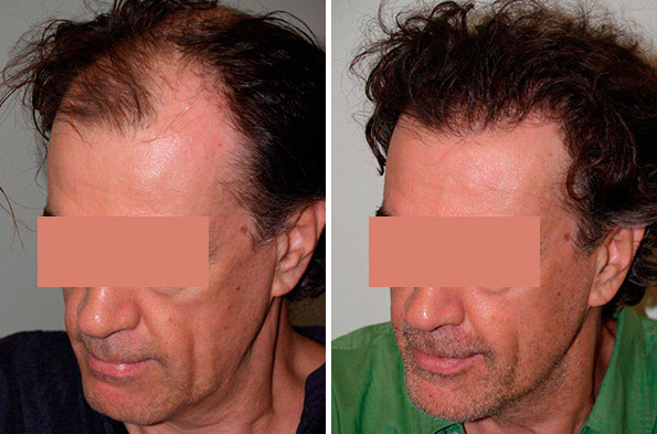 Hair Transplants for Men Before and after in Miami, FL, Paciente 37609