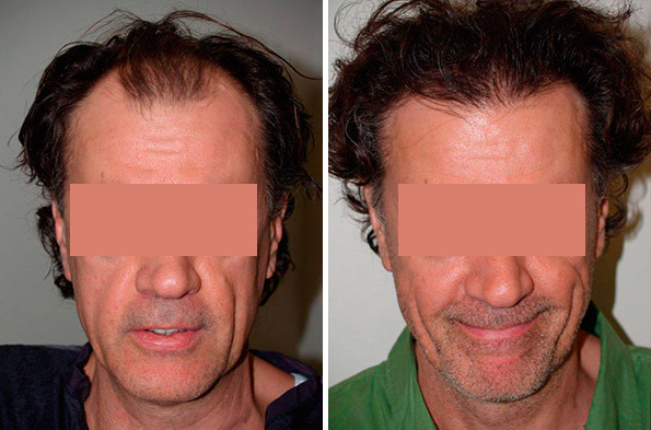 Hair Transplants for Men Before and after in Miami, FL, Paciente 37609