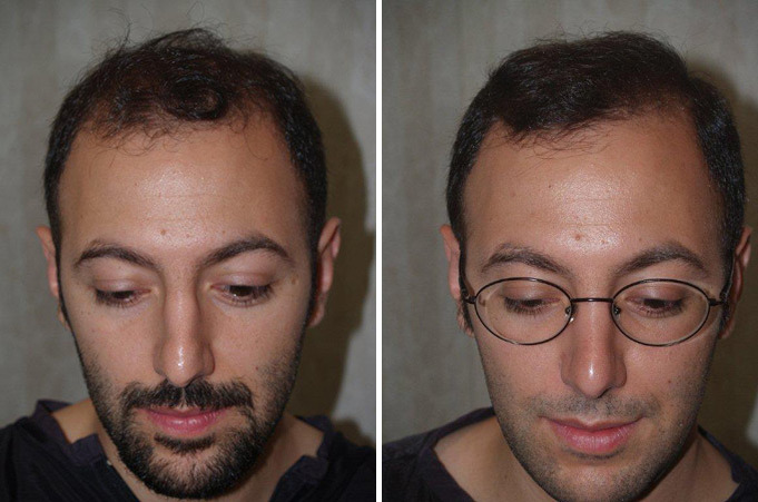 Hair Transplants for Men Before and after in Miami, FL, Paciente 37702