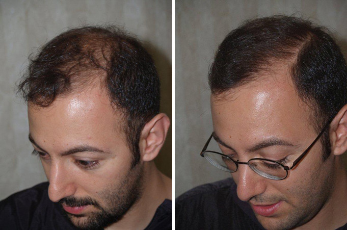 Hair Transplants for Men Before and after in Miami, FL, Paciente 37702