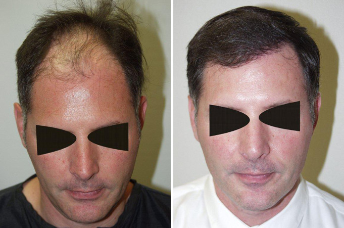Hair Transplants for Men Before and after in Miami, FL, Paciente 39371
