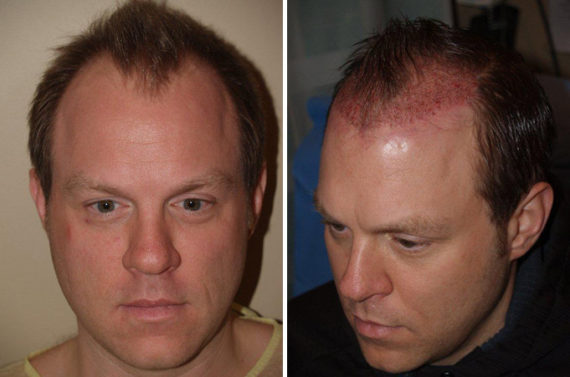 Trasplante de Pelo en Hombres Before and after in Miami, FL, Paciente 78424
