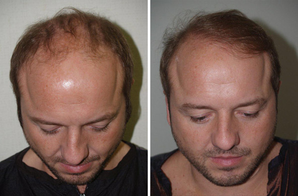 Hair Transplants for Men Before and after in Miami, FL, Paciente 39867