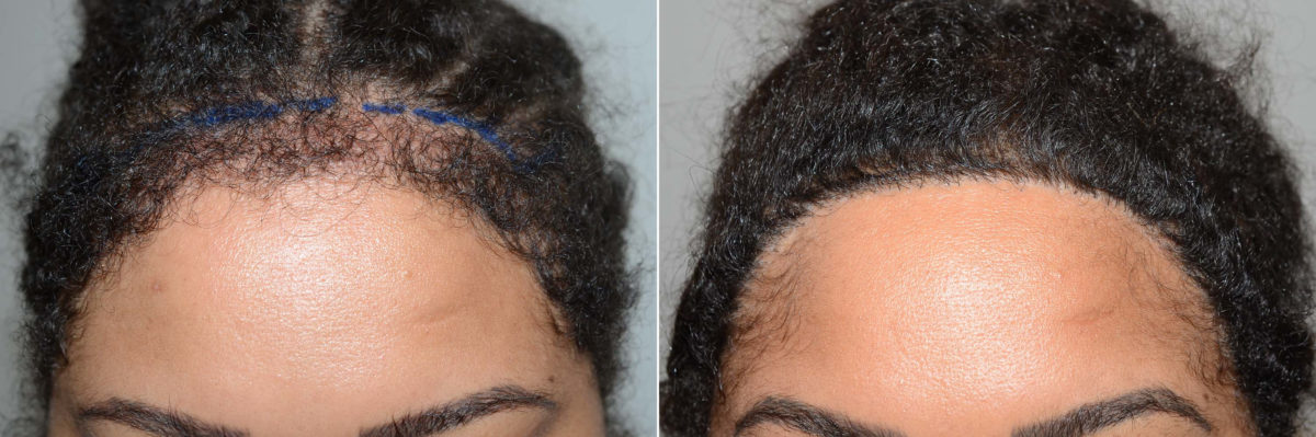 Hairline Advancement Before and after in Miami, FL, Paciente 117311