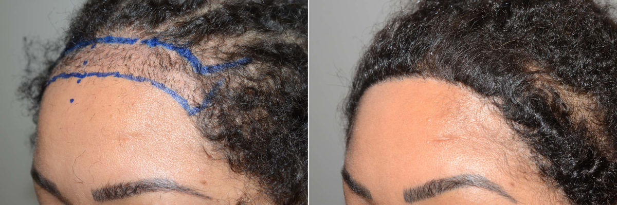 Hairline Advancement Before and after in Miami, FL, Paciente 117311