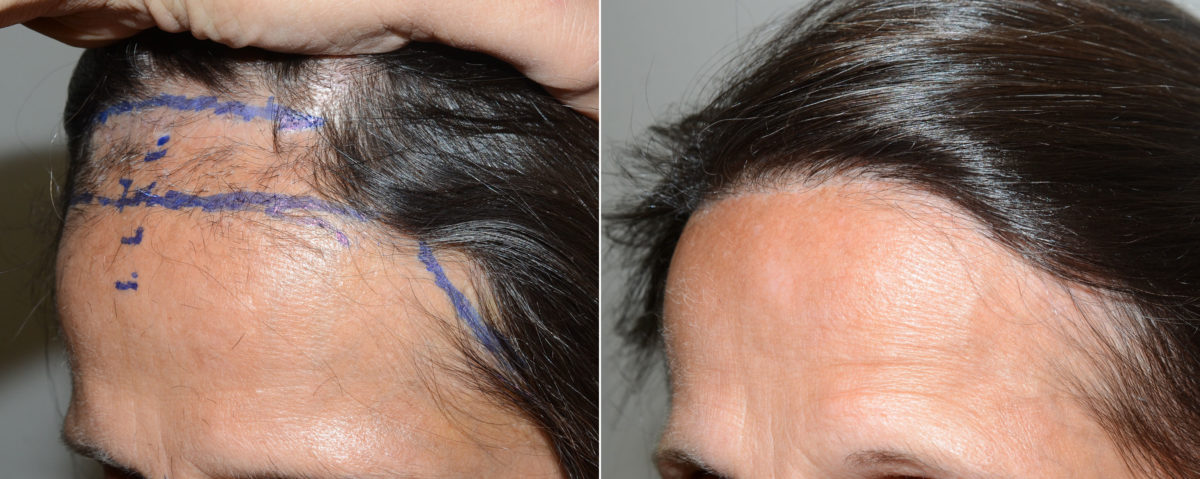 Forehead Reduction Surgery Before and after in Miami, FL, Paciente 120217