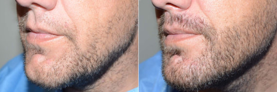 Facial Hair Transplant Before and after in Miami, FL, Paciente 120264