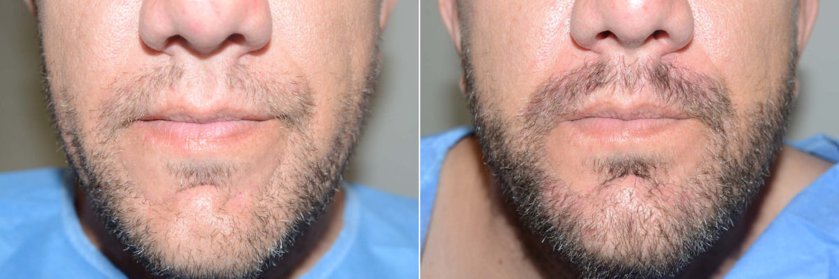 Trasplante de Pelo Facial Antes y después en Miami, FL, Paciente 120283