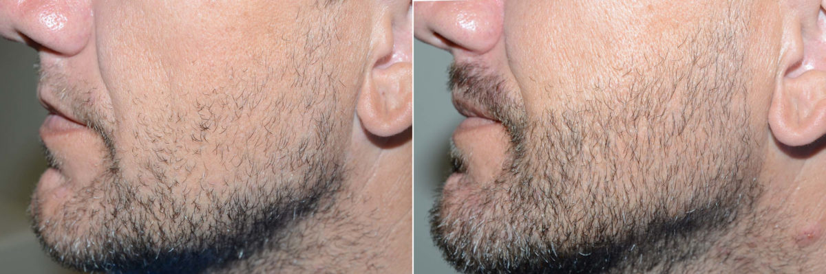 Facial Hair Transplant Before and after in Miami, FL, Paciente 120264