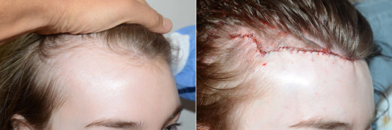 Forehead Reduction Surgery Before and after in Miami, FL, Paciente 120285