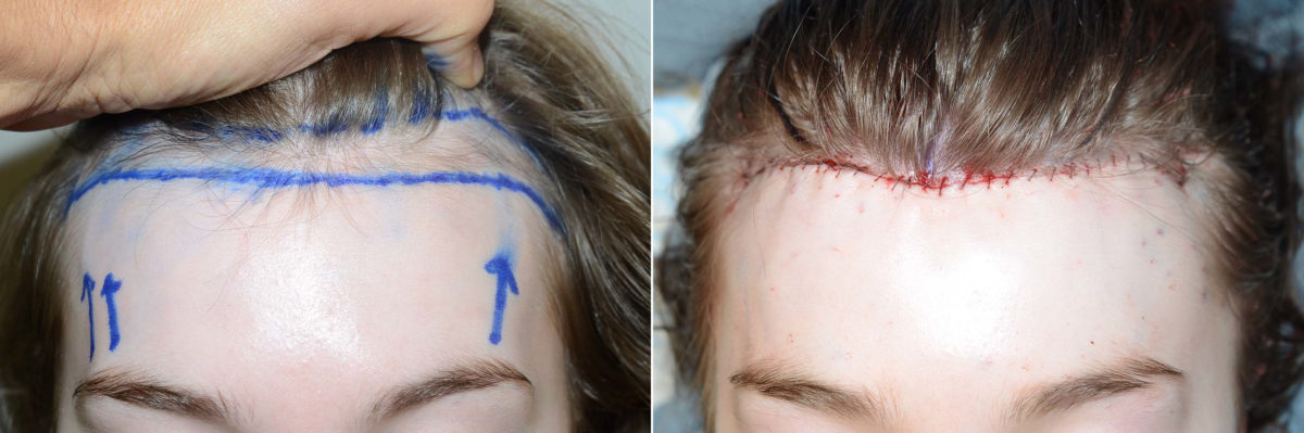 Forehead Reduction Surgery Before and after in Miami, FL, Paciente 120285