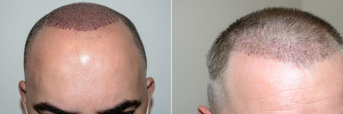 Hairline Advancement Before and after in Miami, FL, Paciente 120329