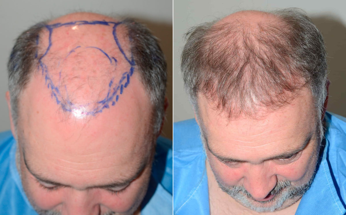 Hair Transplants for Men Before and after in Miami, FL, Paciente 120353