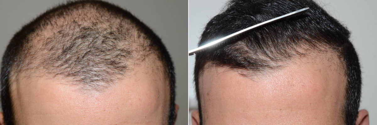Before and After - Frontal View (Close up)