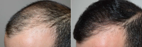 Hair Transplants for Men Before and after in Miami, FL, Paciente 120401