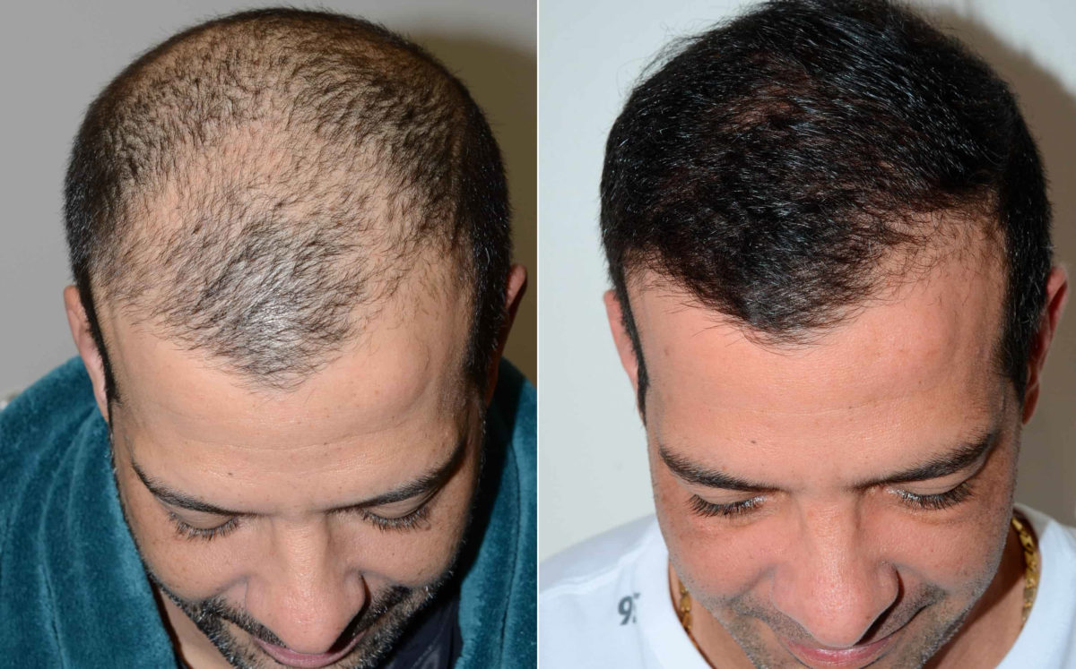 Hair Transplants for Men Before and after in Miami, FL, Paciente 120401