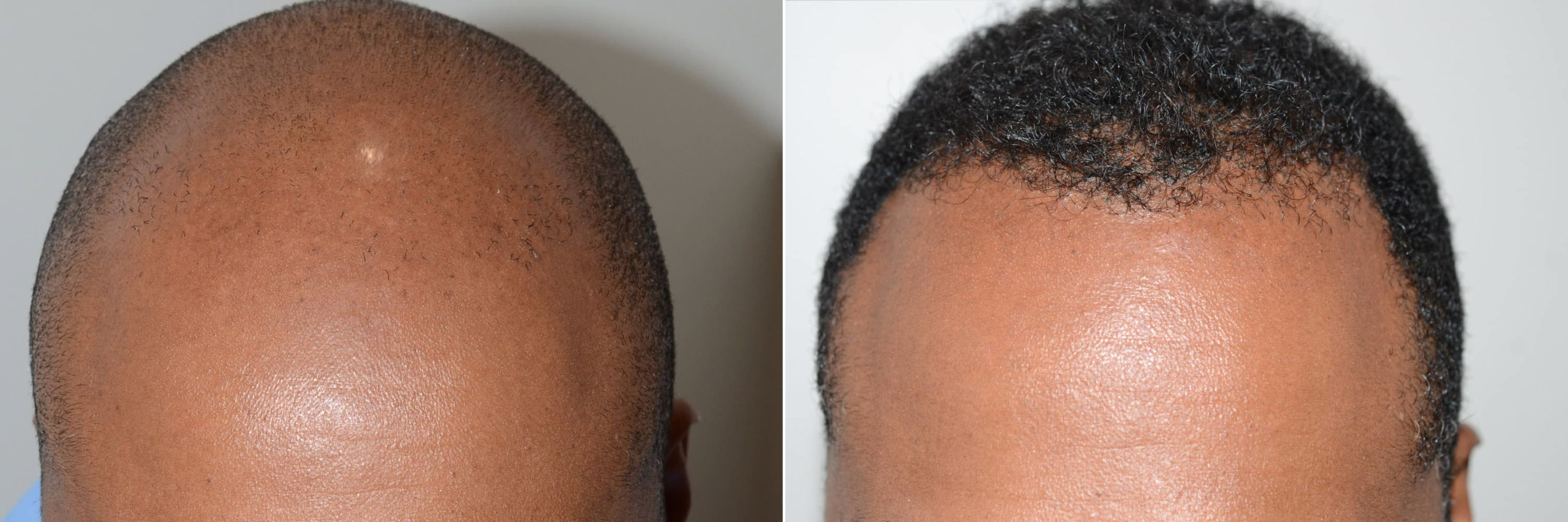 Before and After - Frontal View (Close up)