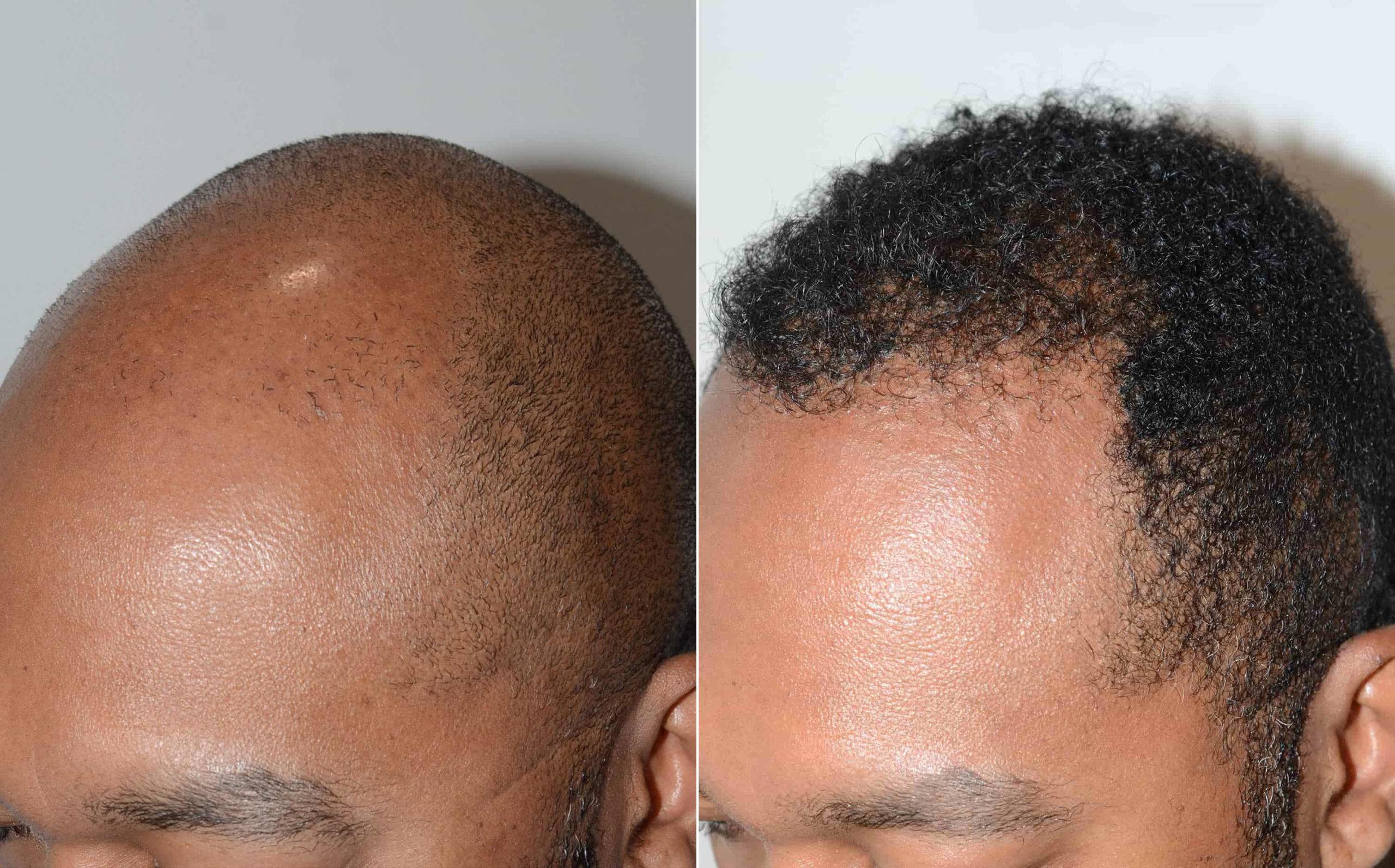 Black hair has unique features and tends to be curly, which can make it more challenging to harvest and transplant during hair restoration.