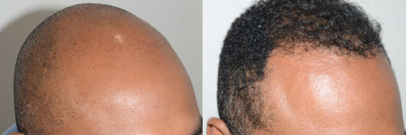 Trasplante de Pelo en Hombres Before and after in Miami, FL, Paciente 120473