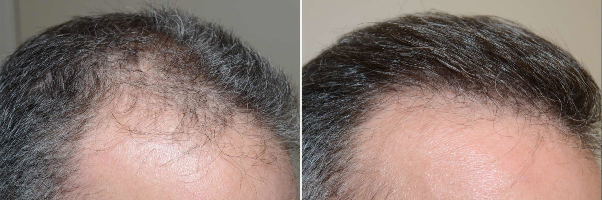Hair Transplants for Men Before and after in Miami, FL, Paciente 120490