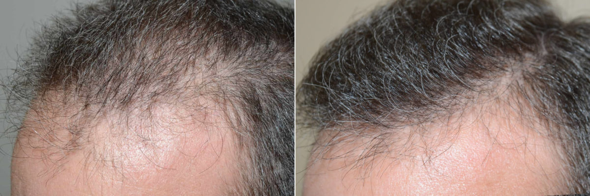 Hair Transplants for Men Before and after in Miami, FL, Paciente 120490