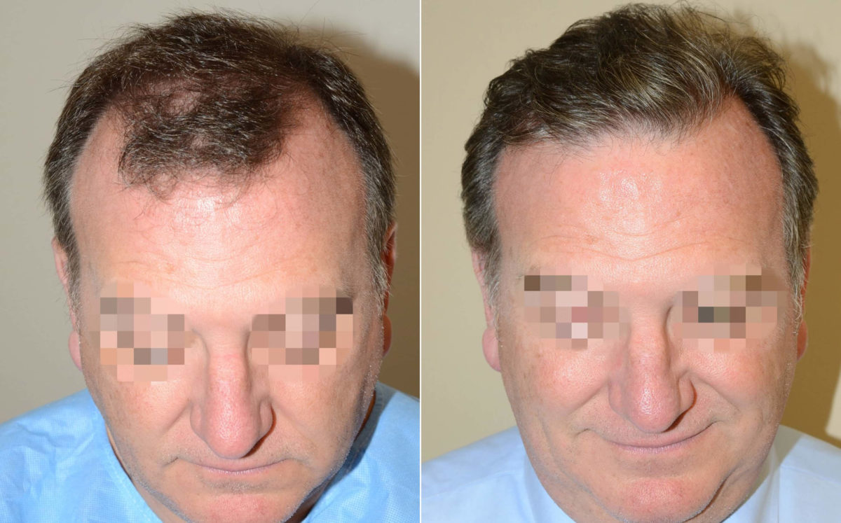 Hair Transplants for Men Before and after in Miami, FL, Paciente 120517