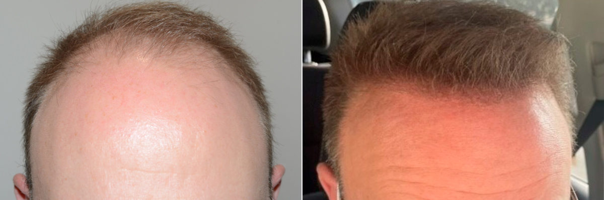 Hair Transplants for Men Before and after in Miami, FL, Paciente 120566