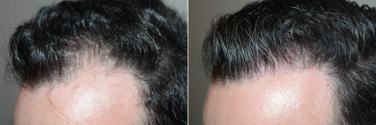 Hair Transplants for Men Before and after in Miami, FL, Paciente 120720