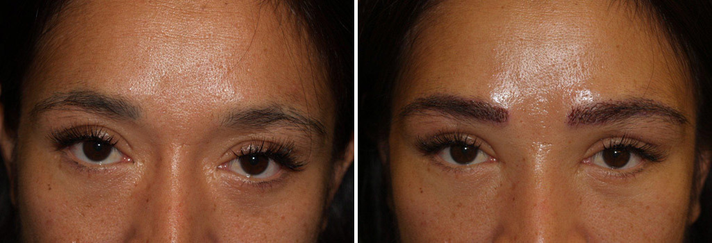 Eyebrow Before and after in Miami, FL, Paciente 35670