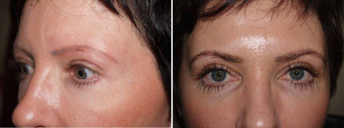 Eyebrow Before and after in Miami, FL, Paciente 35680
