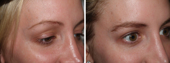 Eyebrow Before and after in Miami, FL, Paciente 35695