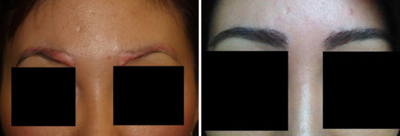 Eyebrow Hair Transplant Before and after in Miami, FL, Paciente 35719