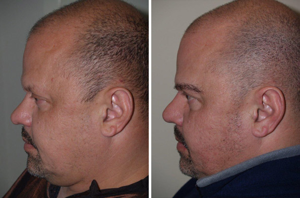 Eyebrow Hair Transplant Before and after in Miami, FL, Paciente 35726