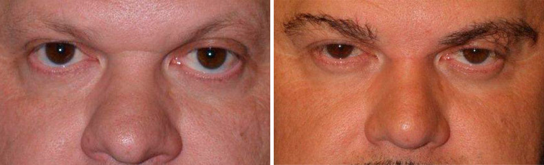 Eyebrow Before and after in Miami, FL, Paciente 35726