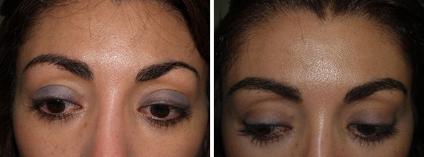 Eyebrow Before and after in Miami, FL, Paciente 35759