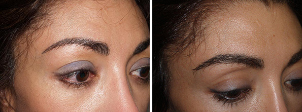 Eyebrow Before and after in Miami, FL, Paciente 35759