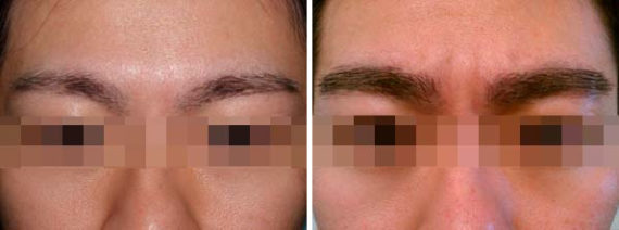 Eyebrow Before and after in Miami, FL, Paciente 35815