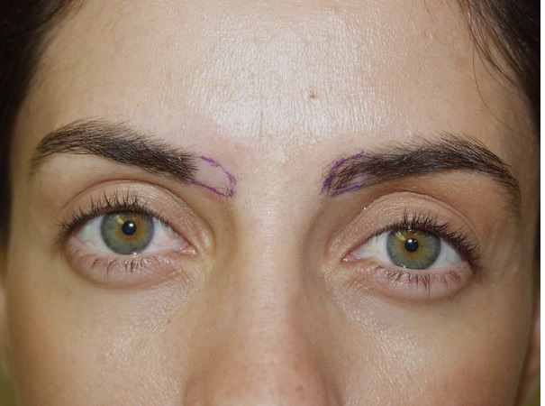 Eyebrow Before and after in Miami, FL, Paciente 35823