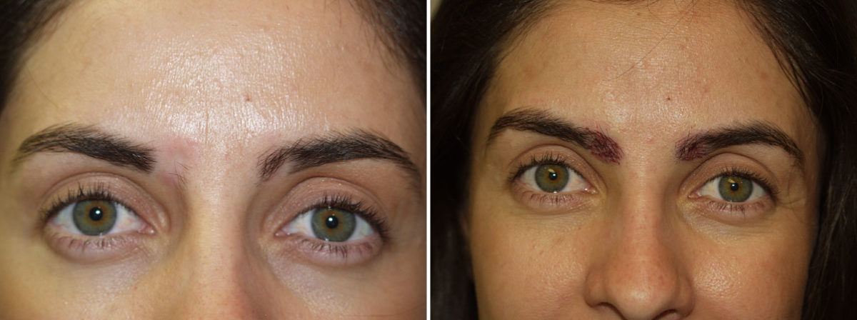 Eyebrow Hair Transplant Before and after in Miami, FL, Paciente 35823