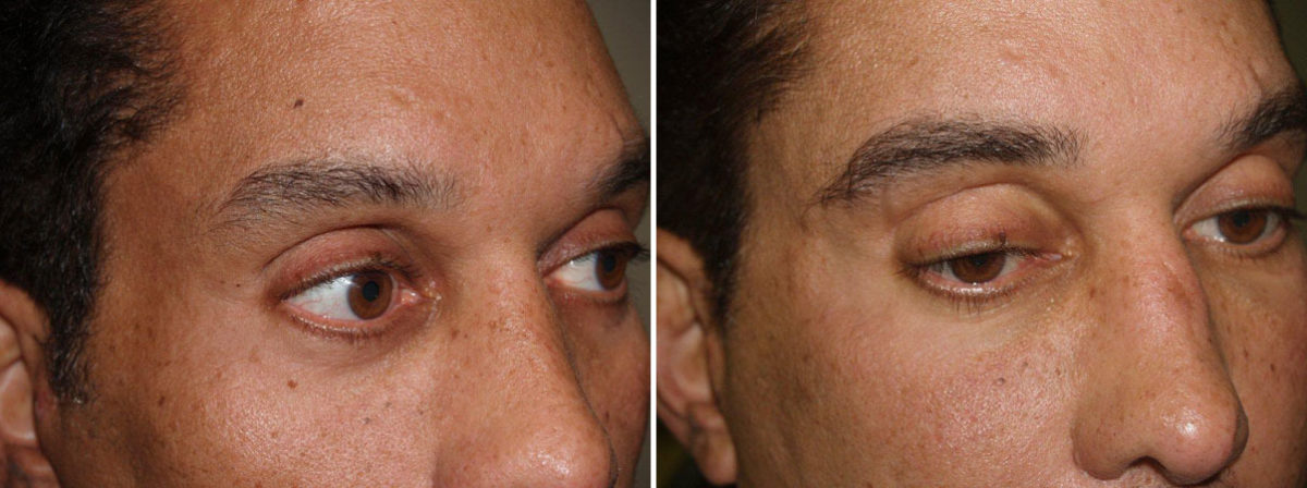Eyebrow Before and after in Miami, FL, Paciente 36126